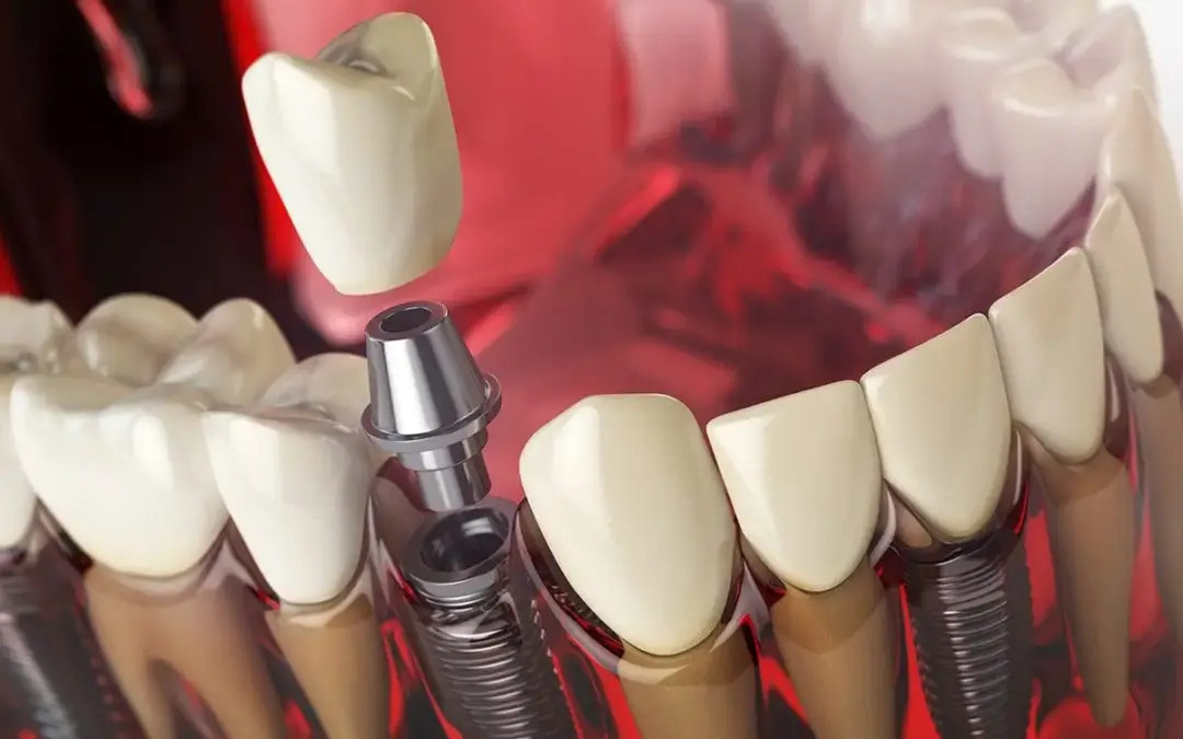 Gli impianti dentali: le cose da sapere